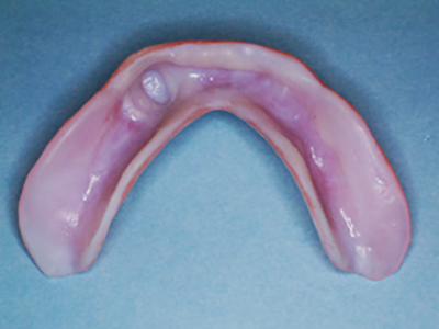 軟性裏装義歯裏側のシリコン面